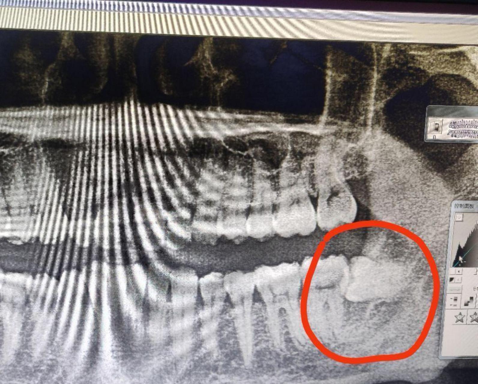 醫生說拔這個牙齒要1000塊,我是不是被騙了?