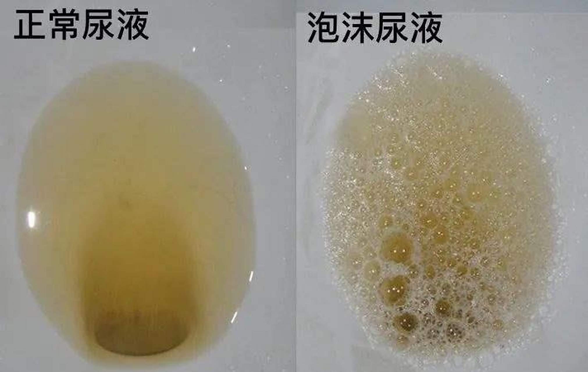 尿蛋白3 会发展到肾衰吗?