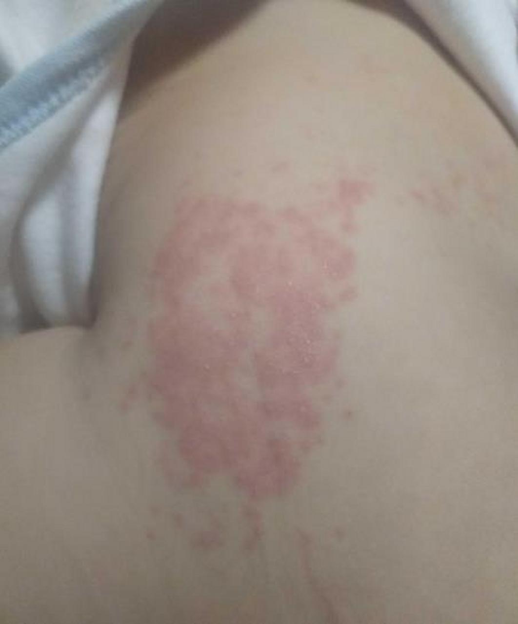 如果是宝宝穿纸尿裤出现的症状,就要考虑宝宝是不是得了尿布疹