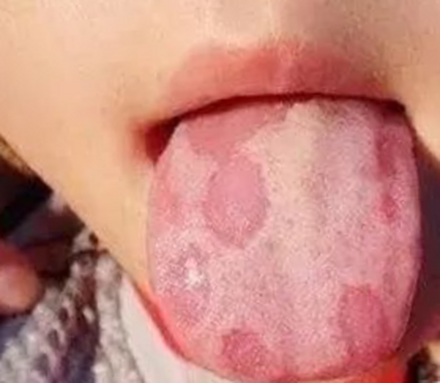 孩子舌红少苔(地图舌) 适用——太子参  脾胃升降功能正常,营养才能源
