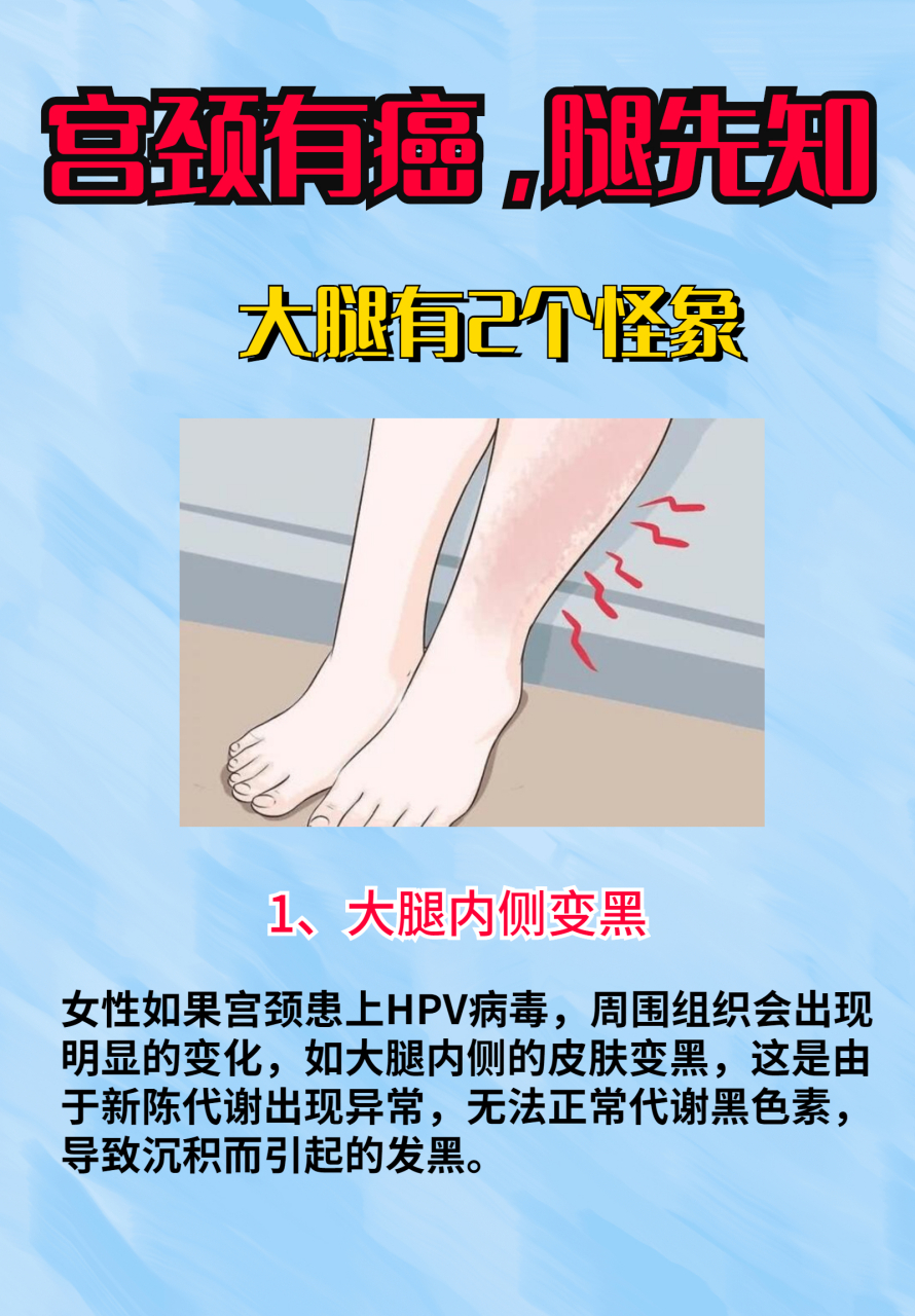 宫颈癌并非悄无声息,腿上有2异样,大概率是"中招"了