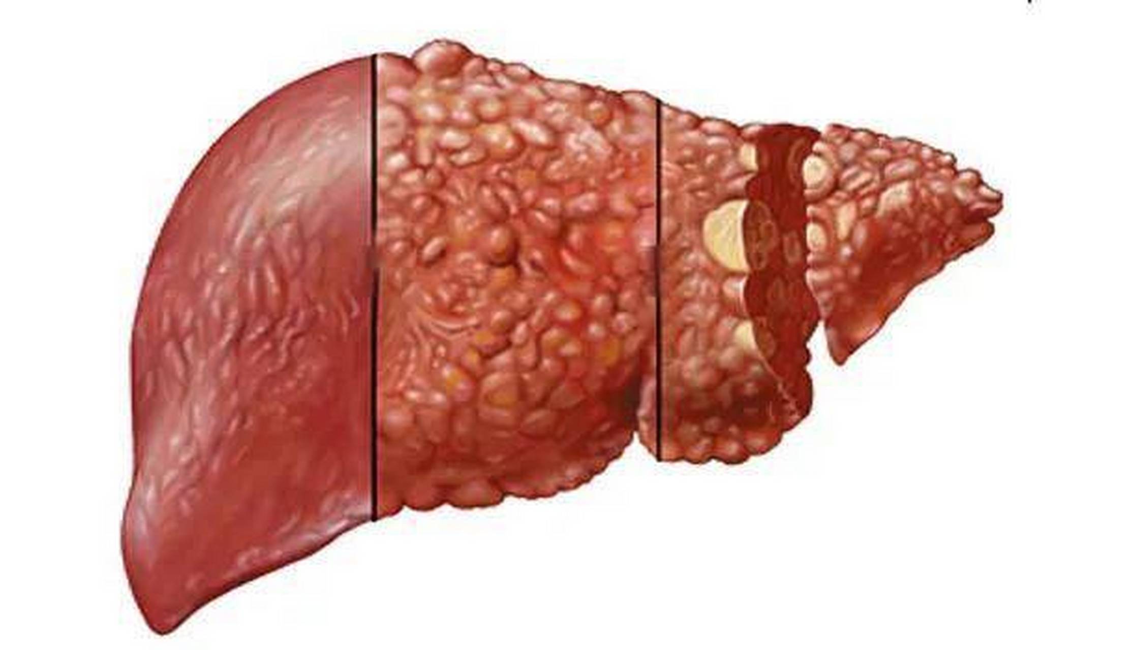 乙肝的肝脏照片图片