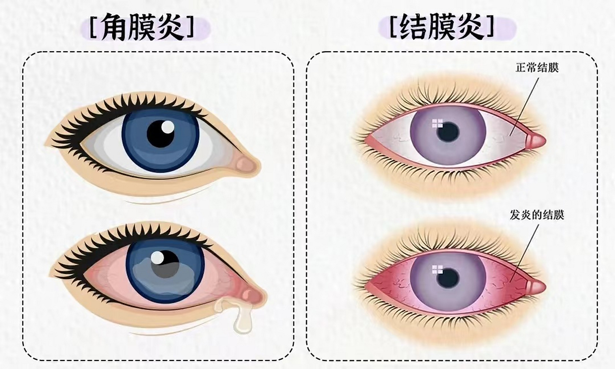 角膜炎,结膜炎)案例分析  今天给大家分享一个案例: 这个患者65岁