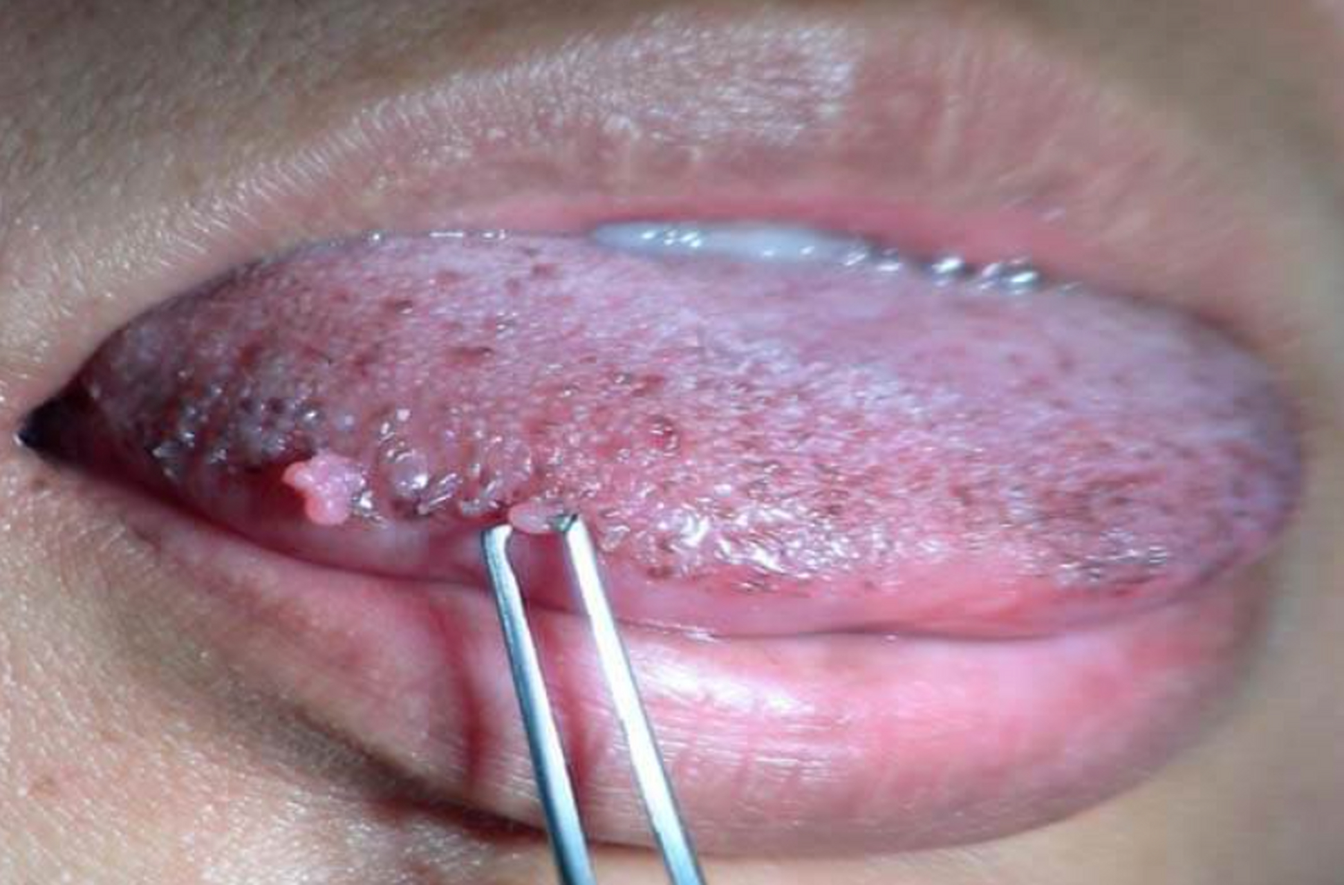 口腔hpv感染的症状图片