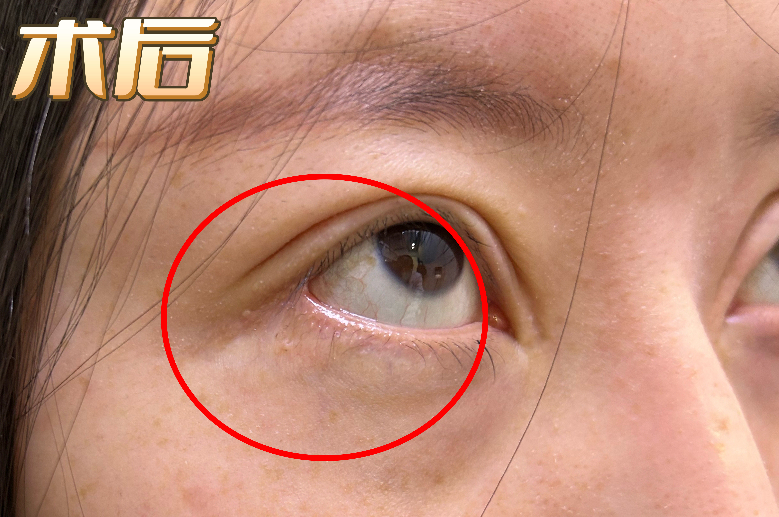 25岁小姑娘,开外眼角失败,外形怪异,眼功能遭到破坏  修复2个月后,与