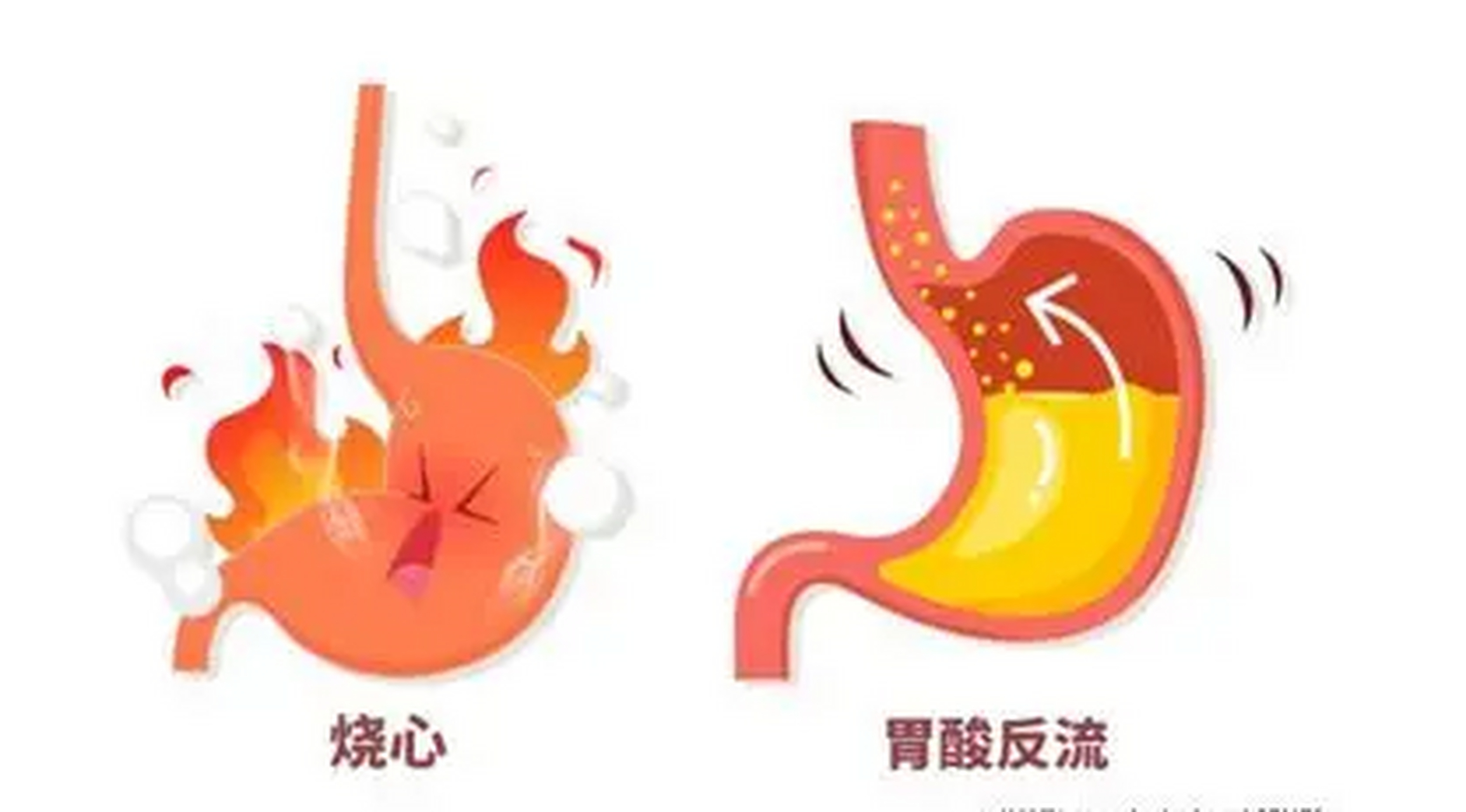 反流性食管炎,饮食上这样吃,避免反酸烧心  得了反流性食管炎,这样吃