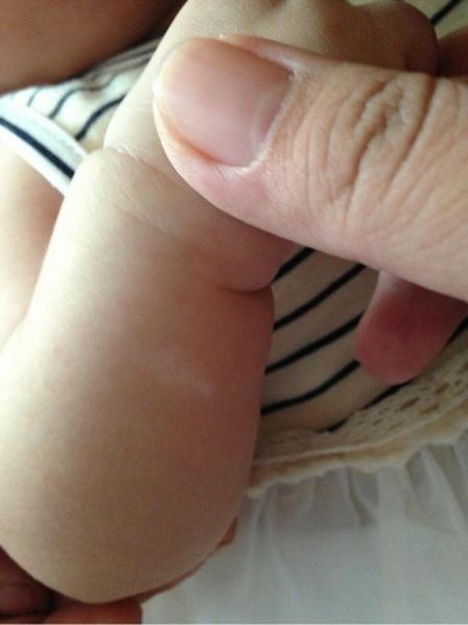 白色糠疹多数患者一般无需治疗,可自行缓解,伴有不适症状的患者