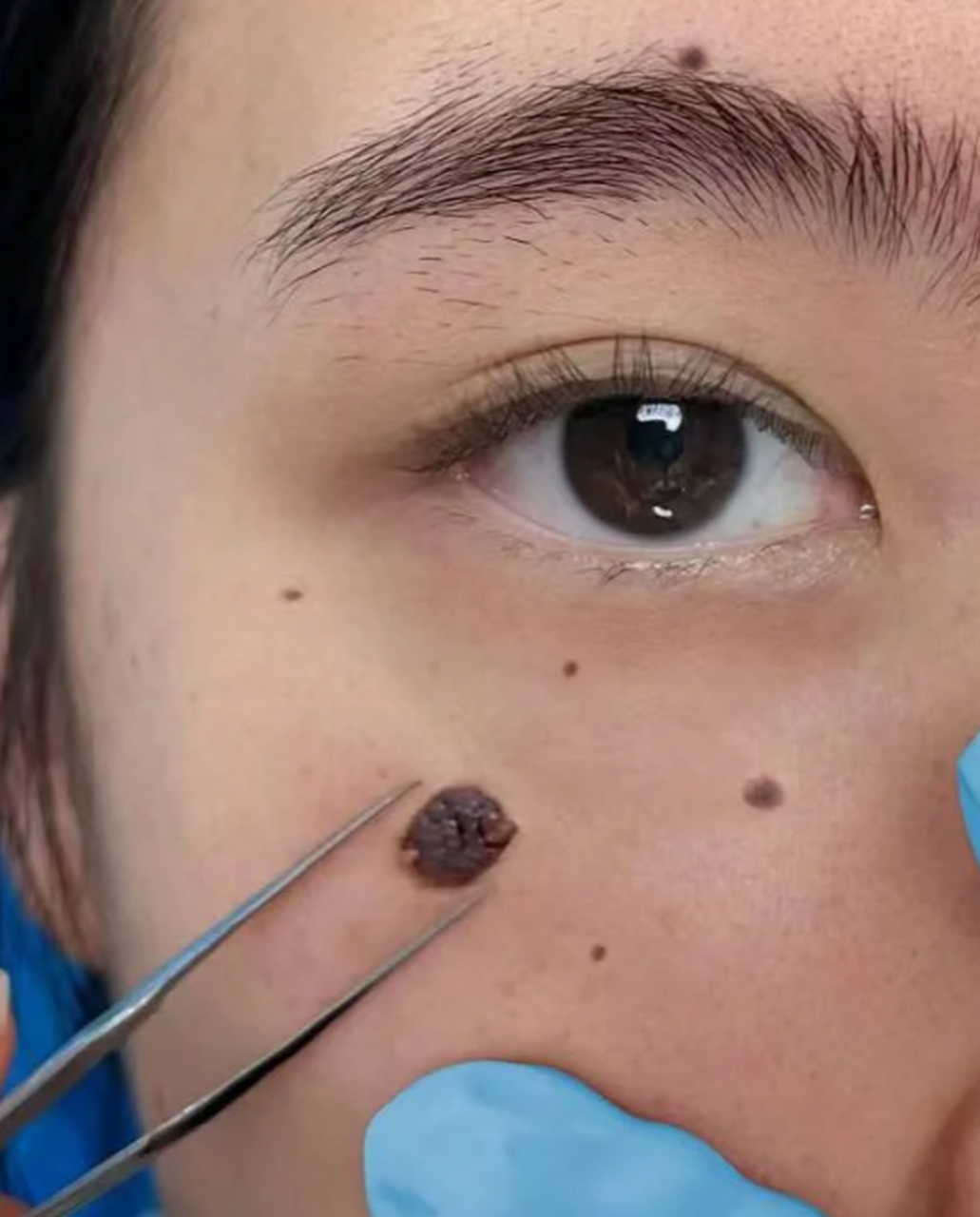 鱼鳞痣怎么去除 #医美科普挑战赛#  鱼鳞痣是一种常见的皮肤病,也被称