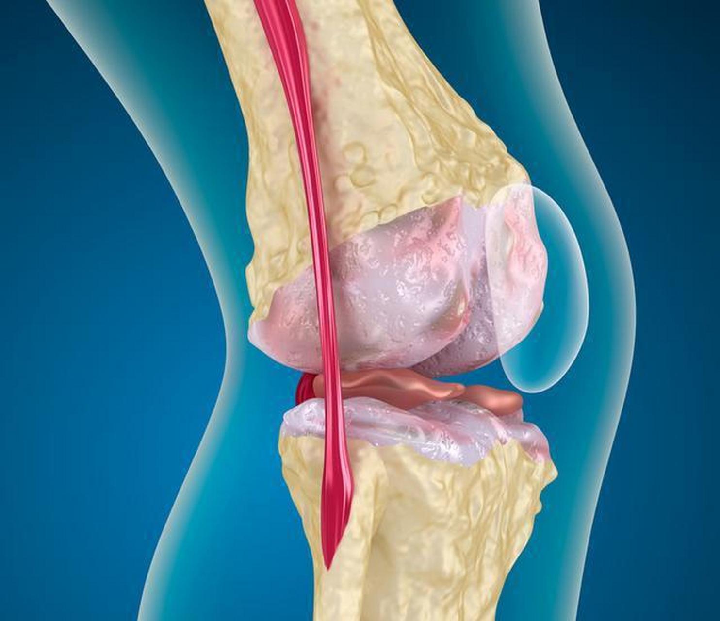 膝关节疼痛的原因有很多,比如骨关节炎,类风湿关节炎,膝关节损伤,痛风