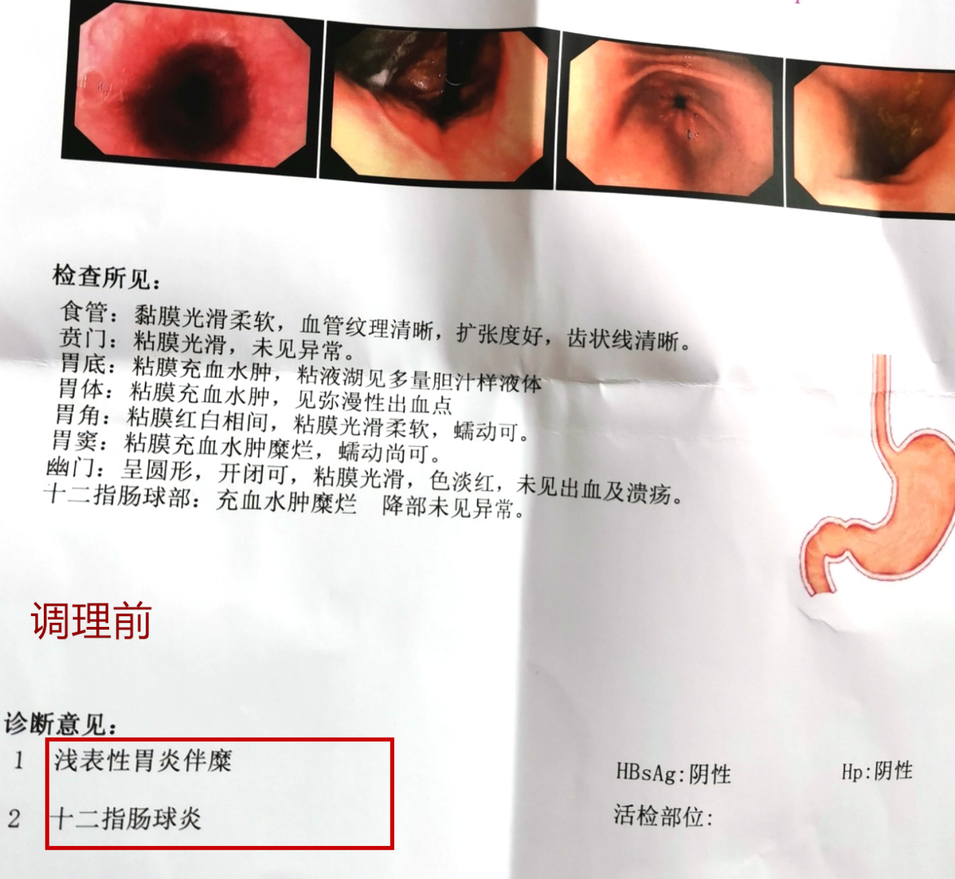 糜烂性胃炎,十二指肠球部溃疡,2个月调理消失  刘先生,40岁,自述早在6