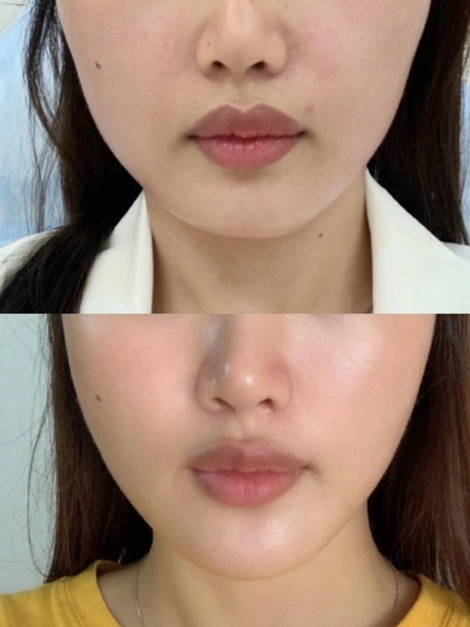 姑娘做了热玛吉一个月后的对比图  热玛吉对脸部的提升确实很明显,脸