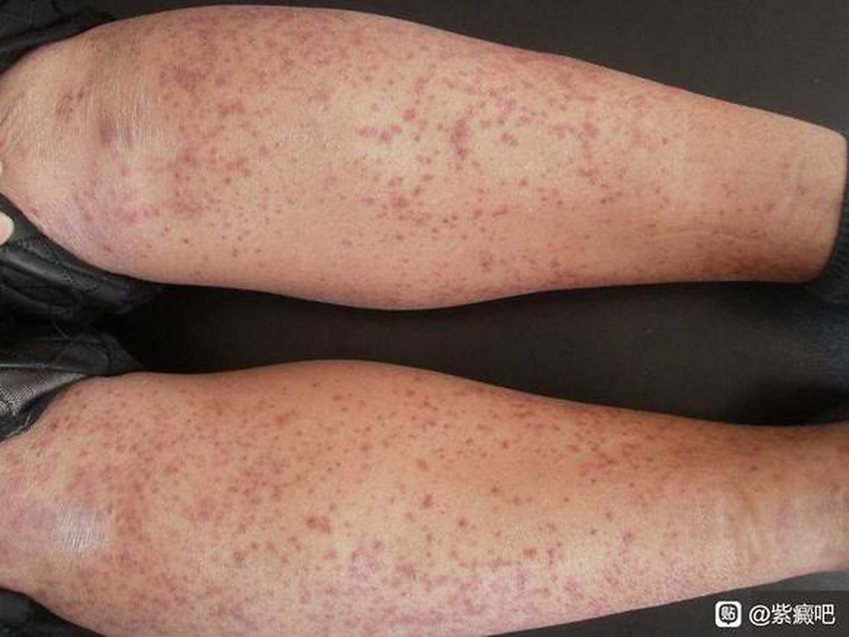 过敏性紫癜患者的生活 3 #过敏性紫癜# #疾病治疗经验# #健康经验笔记