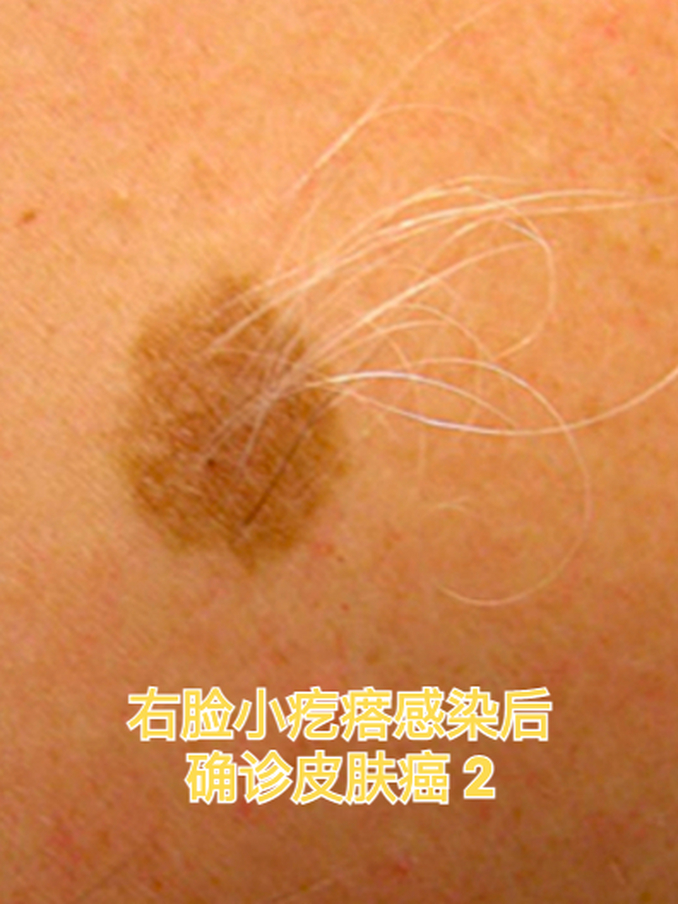 皮肤癌早期治疗图片