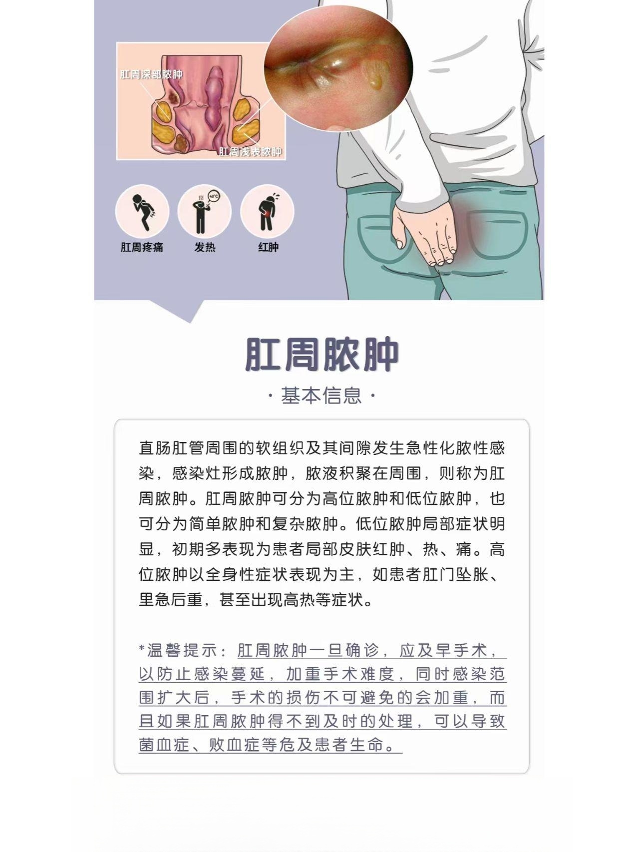 肛漏 原因图片