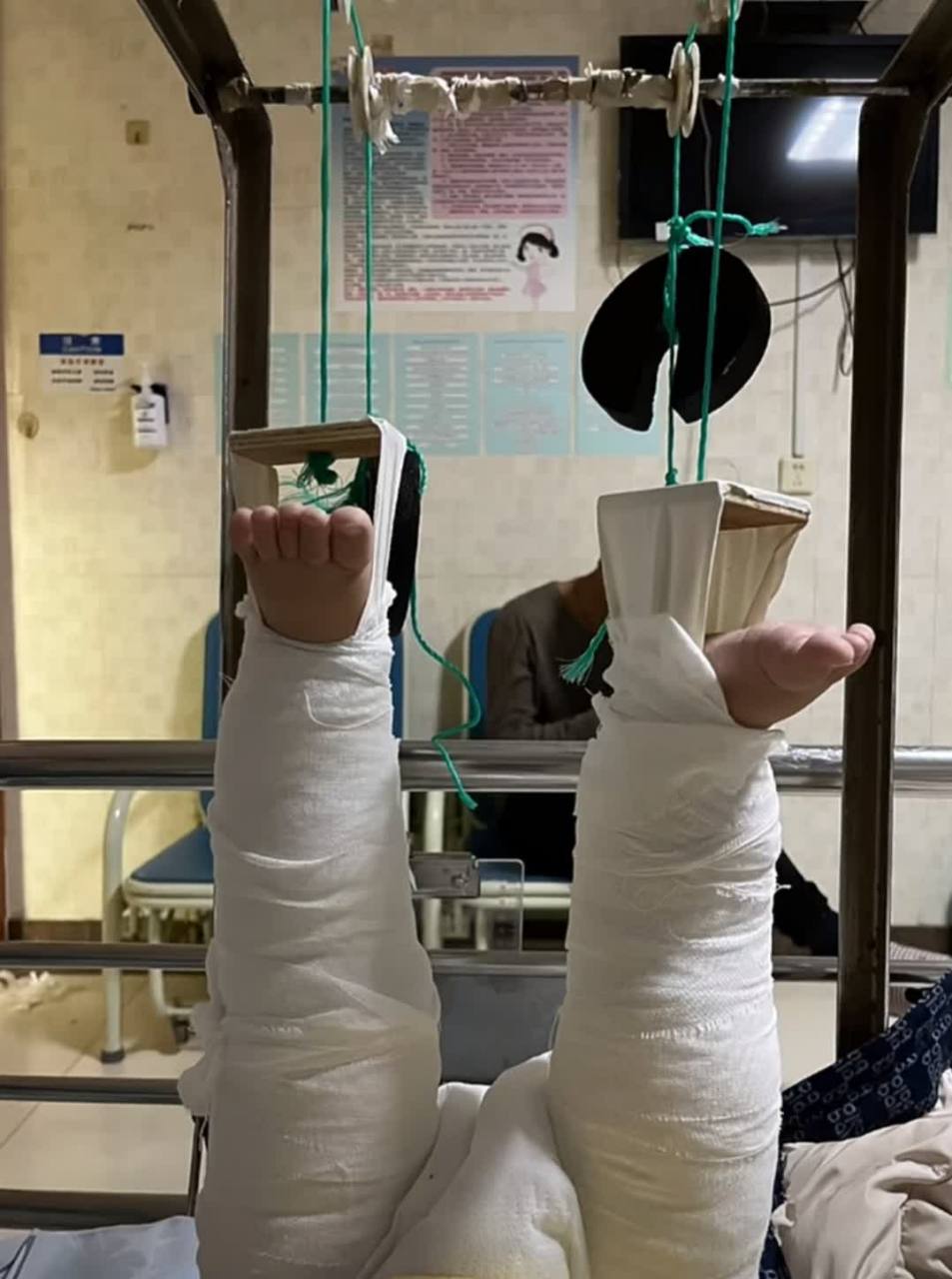 儿子摔断了腿,以后再也不让婆婆照顾孩子了.[大笑][鼓掌]#搞笑