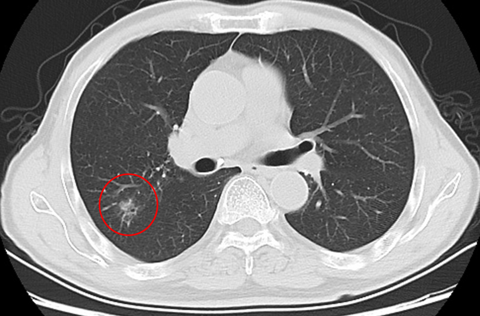 02  大家好,我是姜岳医生.  肺结节和肺癌,它们之间有关系吗?