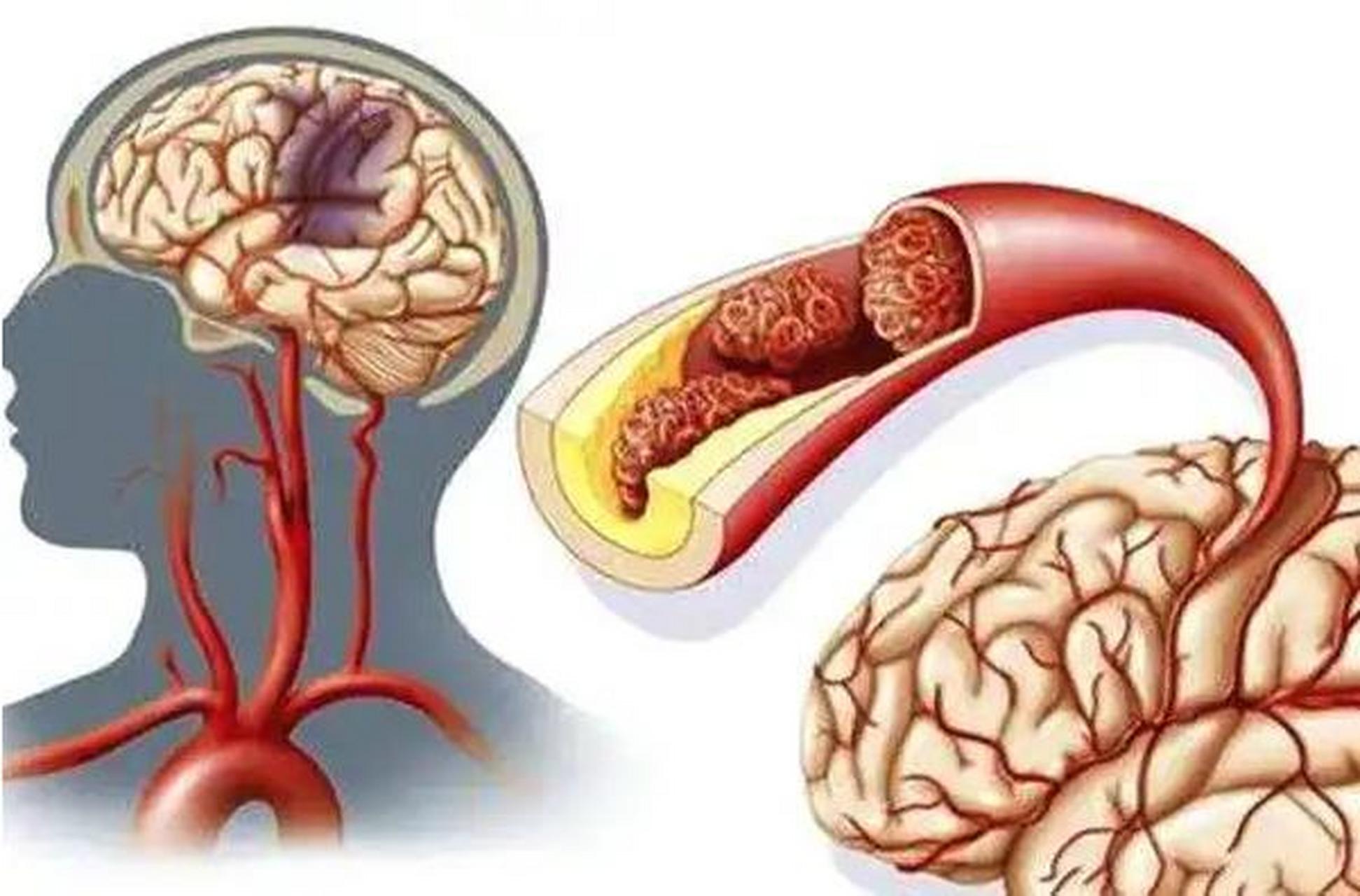 脑血管动脉硬化,中医能介入吗 脑血管动脉硬化是现代医学的病例名词