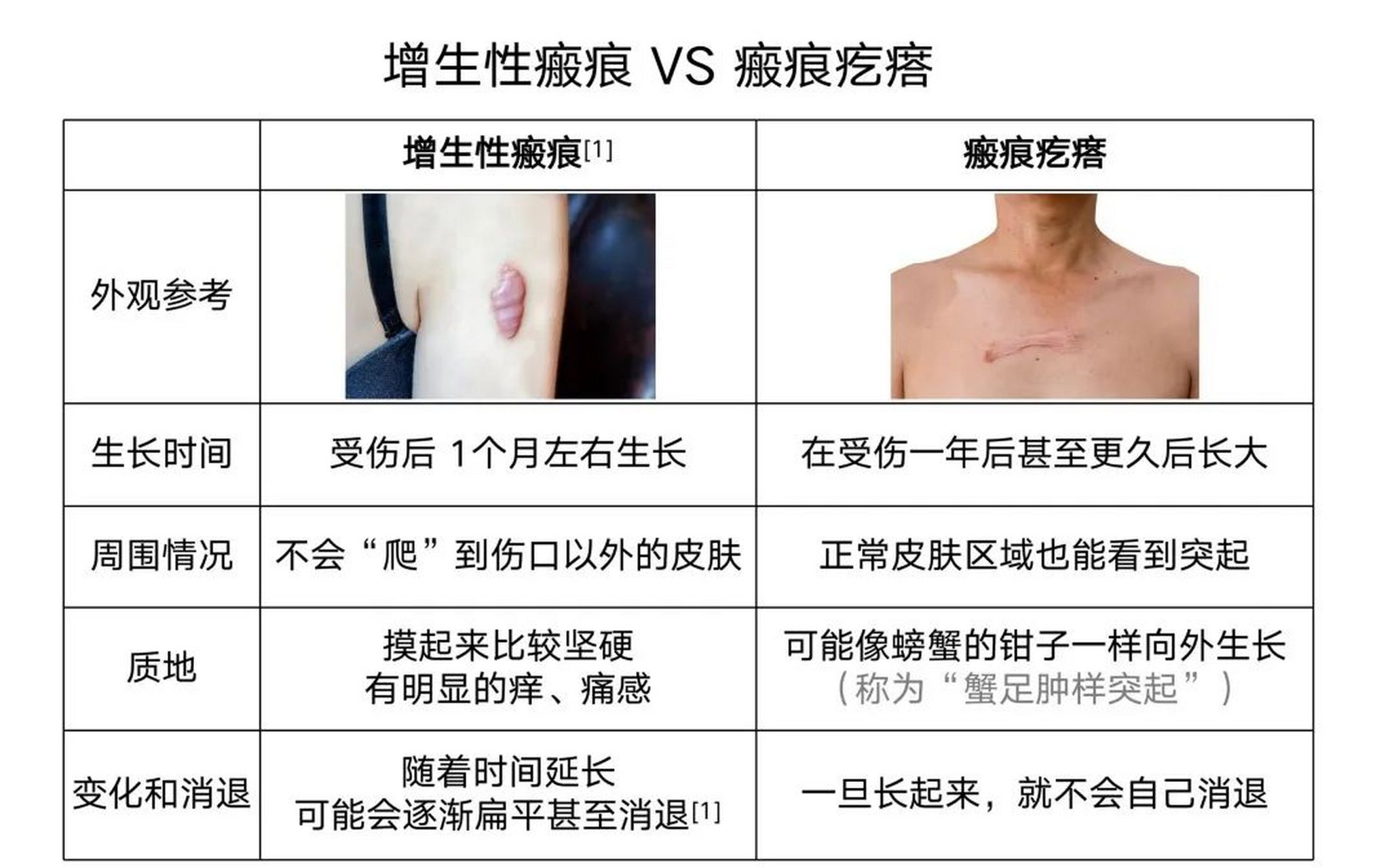 瘢痕疙瘩 初步形成图片