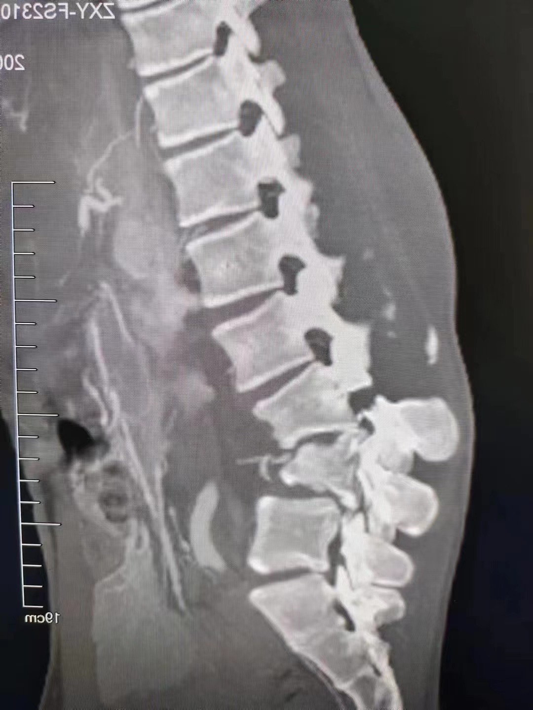 17岁的少年,在工地被水泥块砸伤,腰3,腰4爆裂骨折