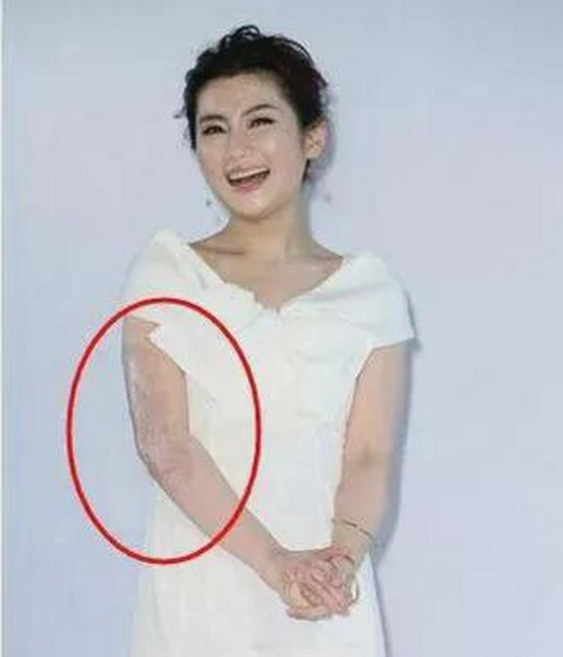 2010年,任家萱拍戏时意外被大火烧伤,不过未婚夫张承中不但没抛弃她