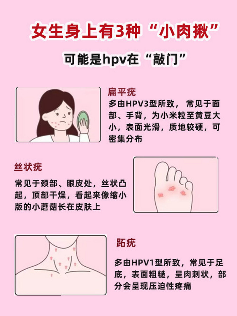 有3种小肉揪,可能是hpv来"敲门"!