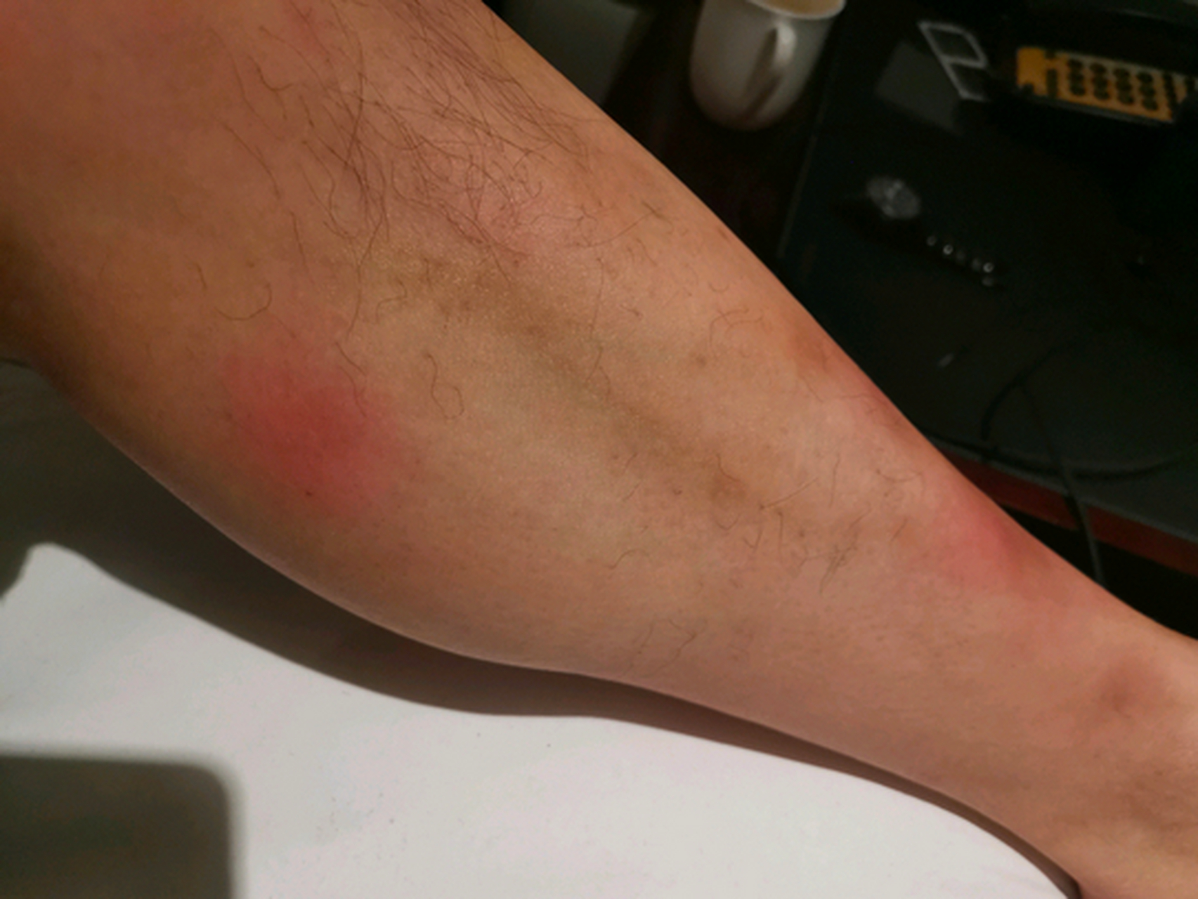 结节性红斑治疗过程 一 #结节性红斑# #疾病治疗经验# #健康经验笔记