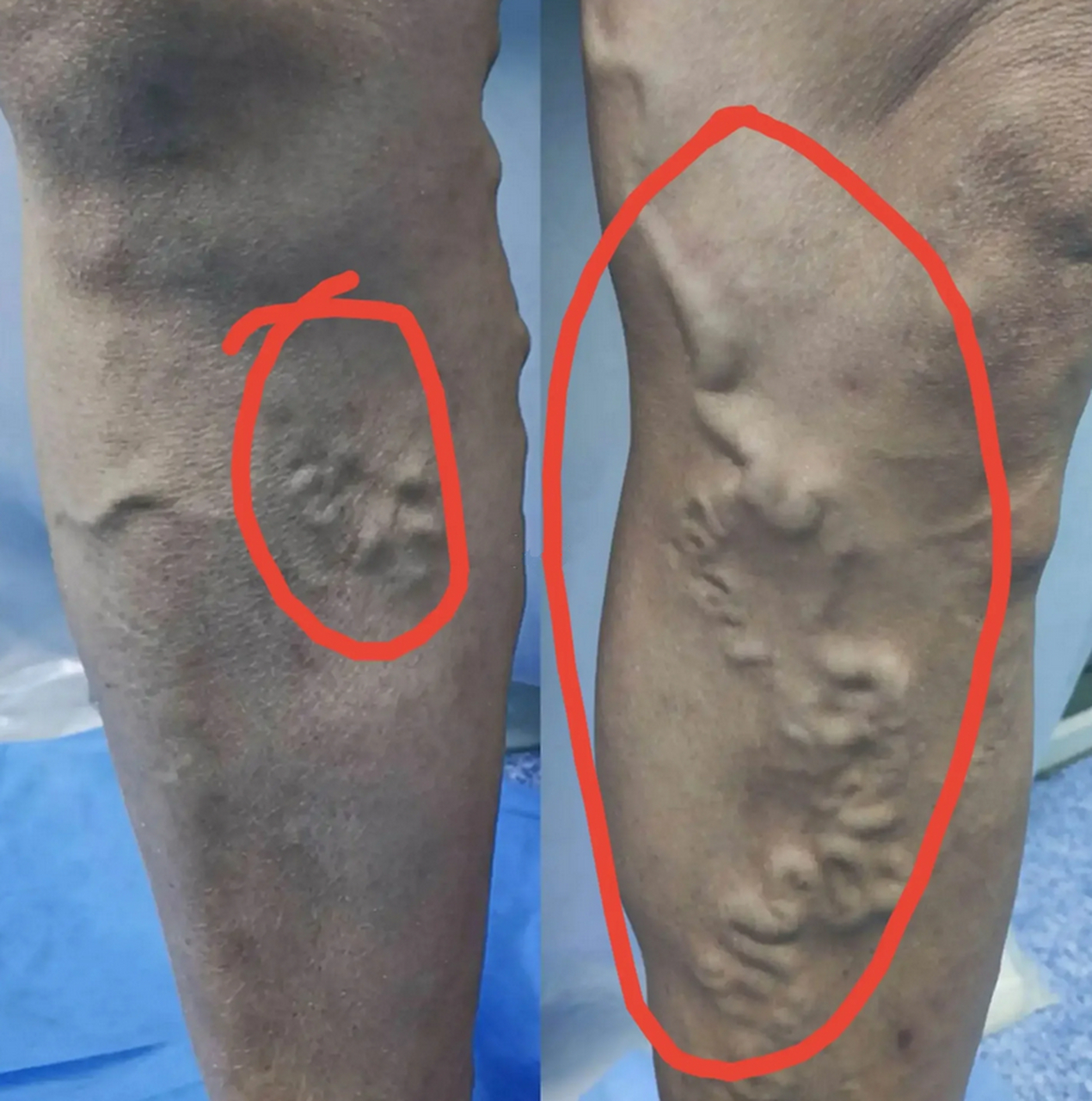 今天来了一个患者,静脉曲张c5级,酸胀发痒严重,有明显色素沉着,达到微