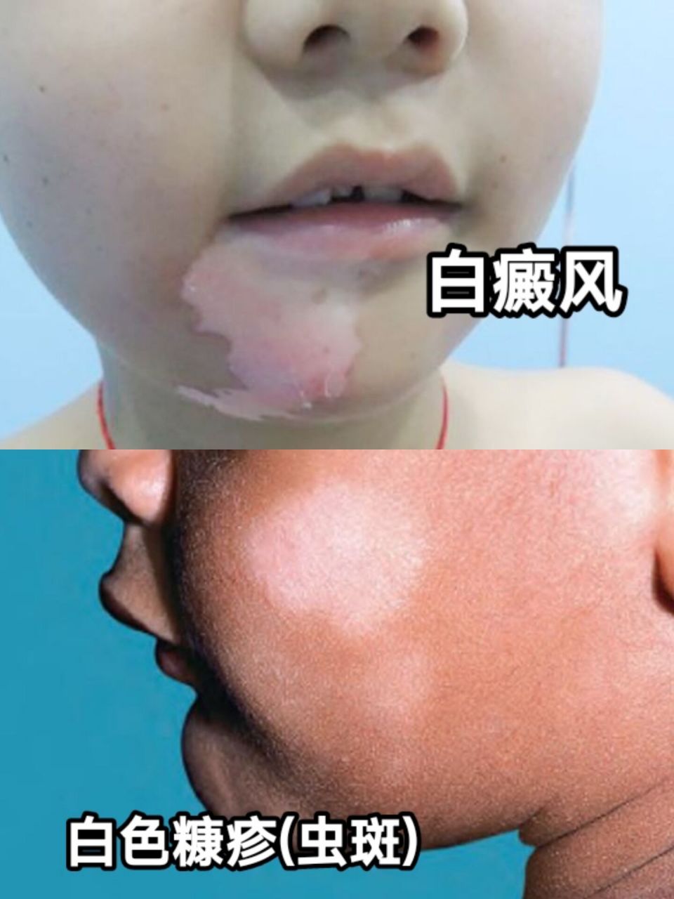 娃娃脸上的白斑是白色糠疹还是白癜风?