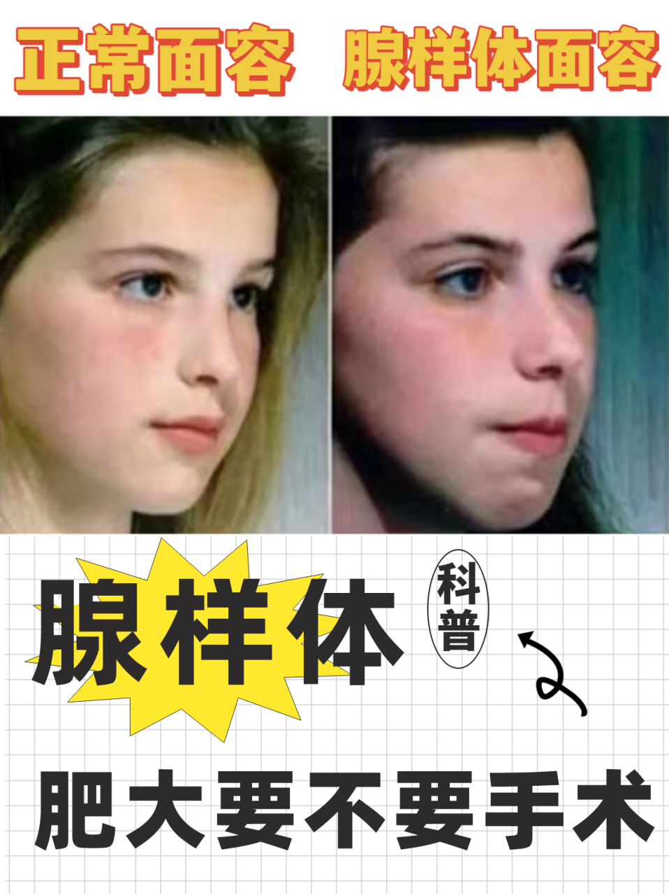 "也成了各位家长关注的话题,上个周接诊了几十个腺样体肥大的孩子