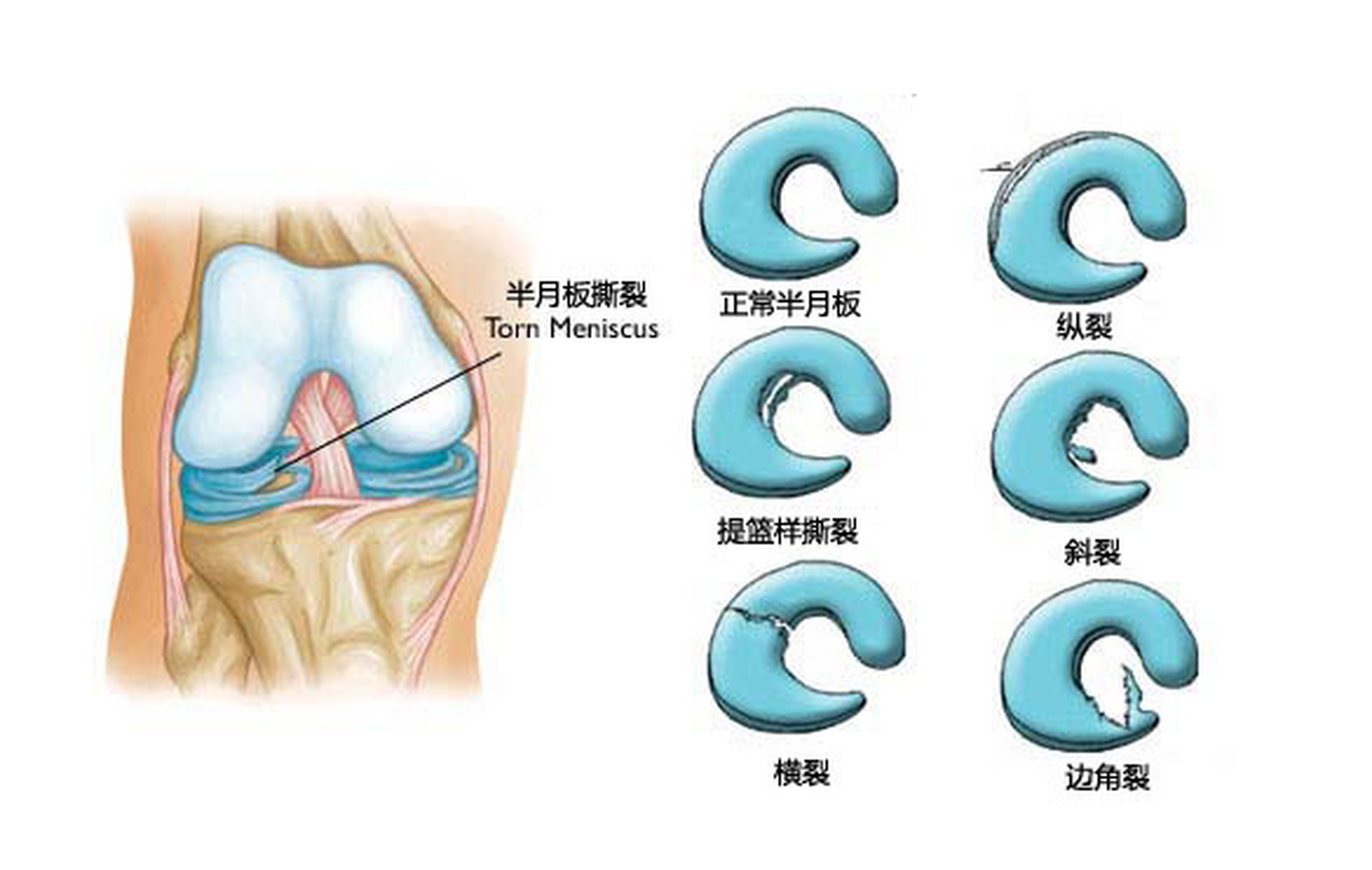半月板是构成膝关节的重要结构之一,是两个半月状纤维软骨,可种持
