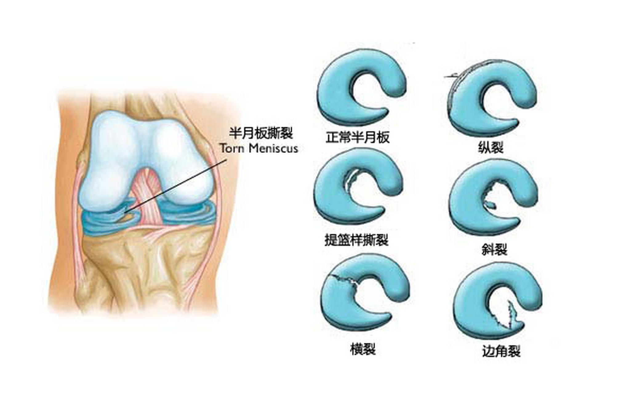 膝关节半月板图解图片