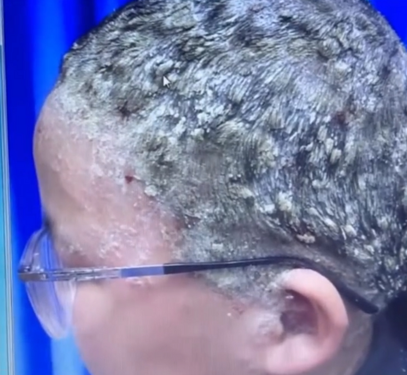 中医讲,大部分的牛皮癣是血热风燥引起的,这就好像是说牛皮癣患者体