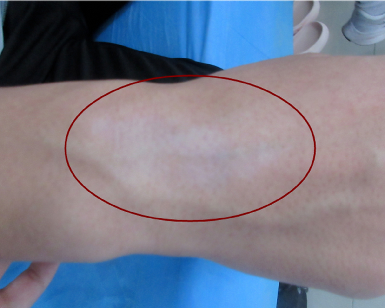 手上长白斑,偏方涂抹伤害大  就白癜风的治疗效果来看,手部白癜风治疗