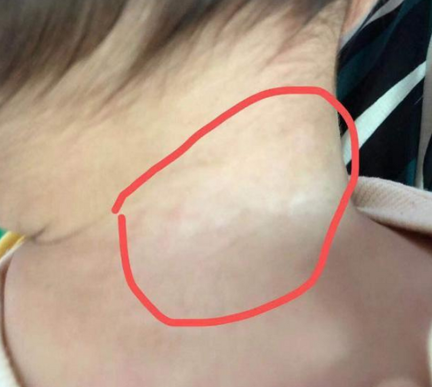 色素减退是什么,需要治疗吗?