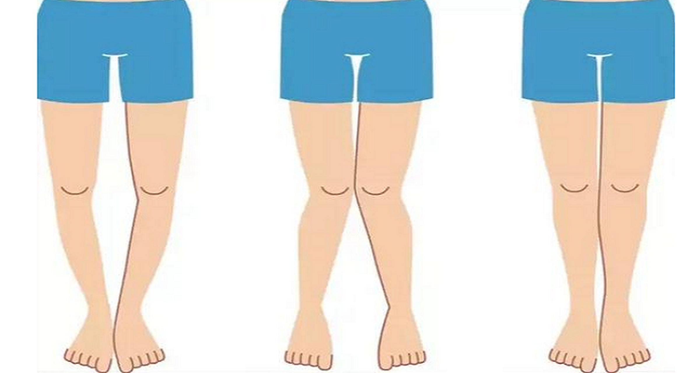 孩子外八或内八的出现与儿童腿部和脚部内外肌肉力量的不平衡眯切