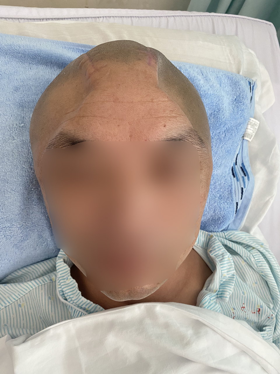 42岁男性患者,高空坠物砸伤致重型颅脑损伤,急诊术后双侧大面积颅骨
