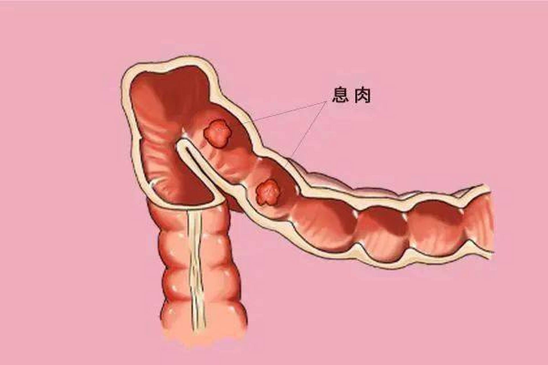 直肠癌和肠息肉有什么关系?