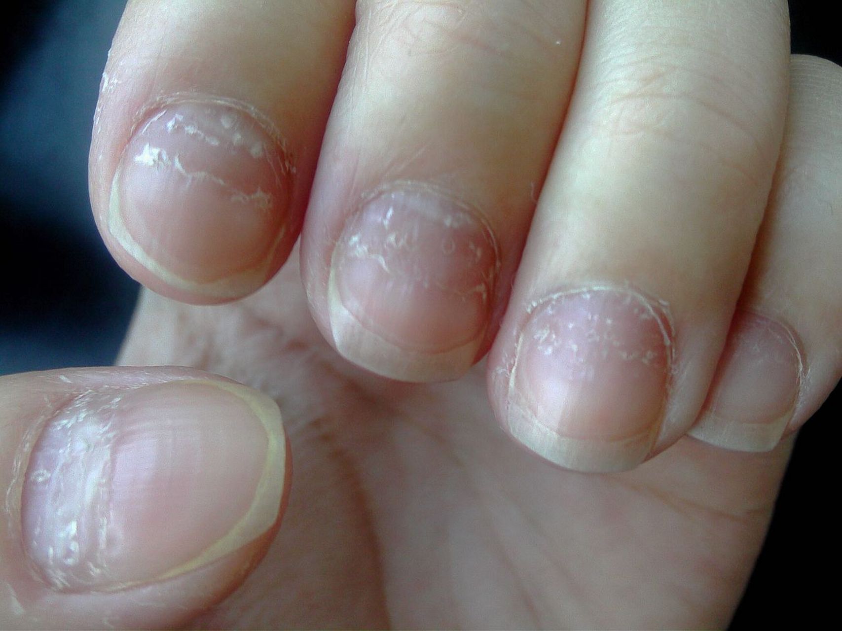 【心脏不好的人,指甲会有4个表现,若没有,恭喜你心脏功能还不错】!