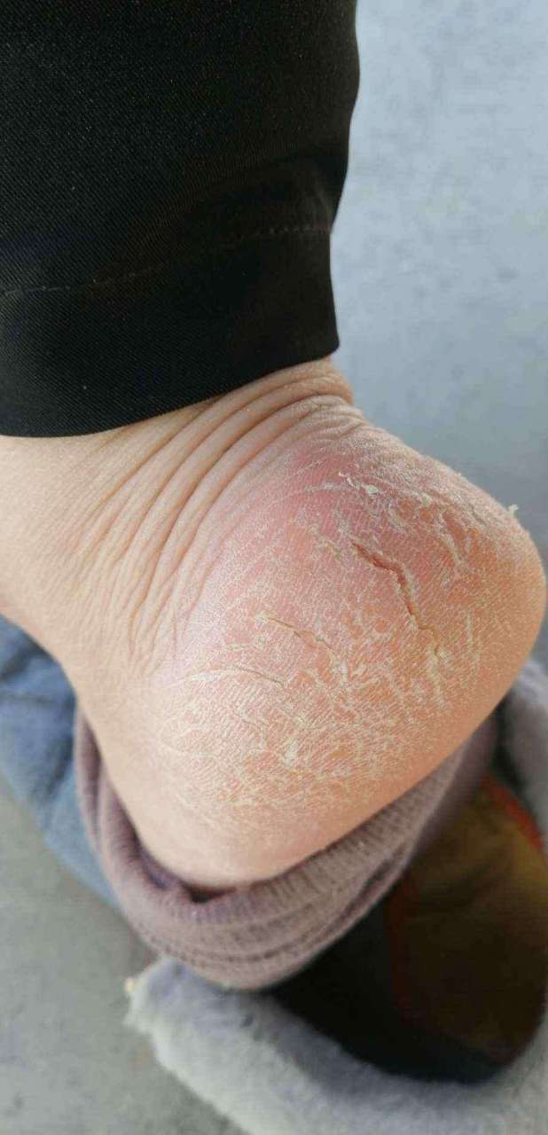 脚后跟干裂起硬皮,摸着挂手,怎么办?