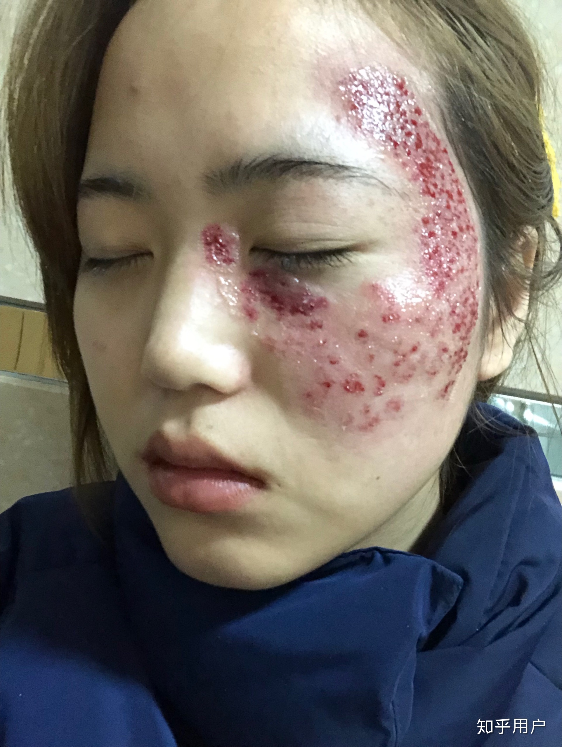 太田痣激光术.@胎记医生郭先锋的动态