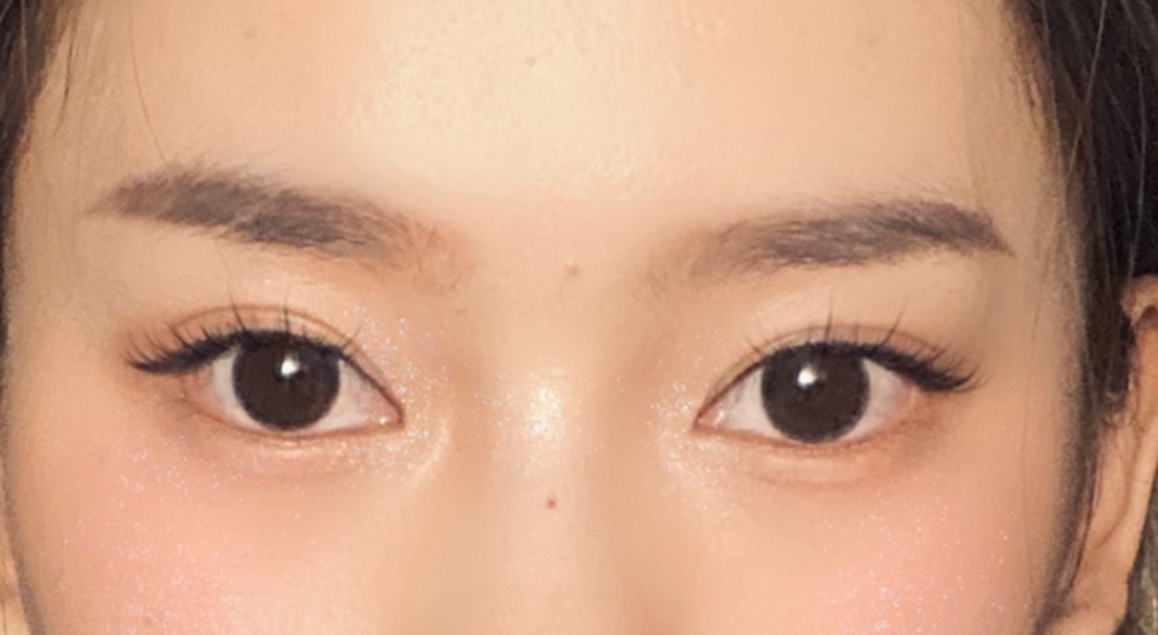 来看看新月形的双眼皮,做了全切提肌 开眼角#双眼皮