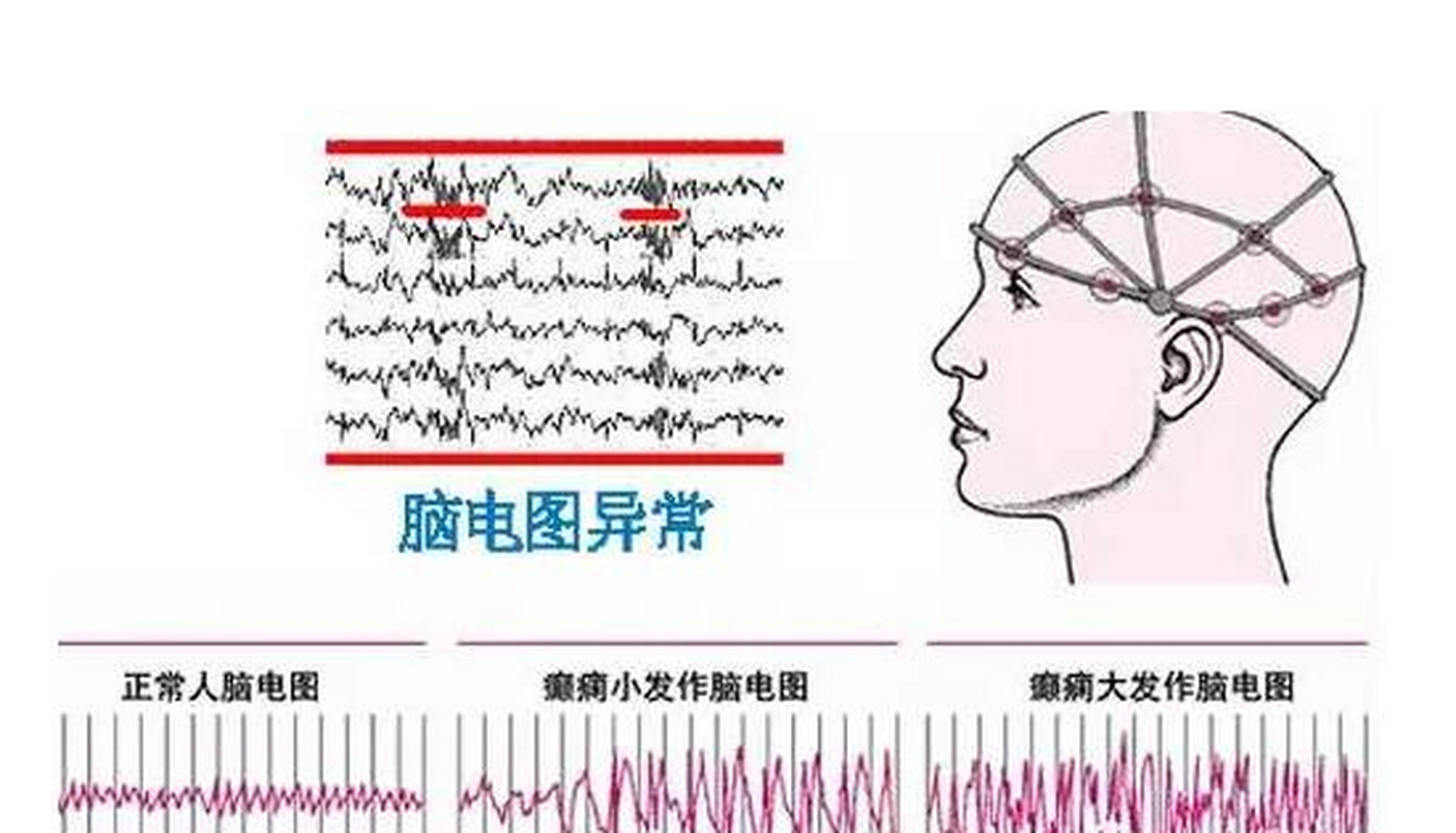 脑电图异常放电图片图片