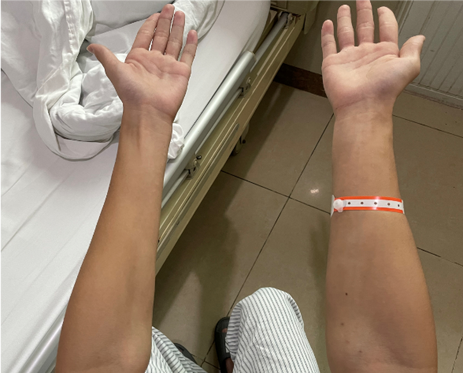 1年前出现左前臂无力,逐渐出现手部及前臂肌肉萎缩,伴左手震颤,冬季