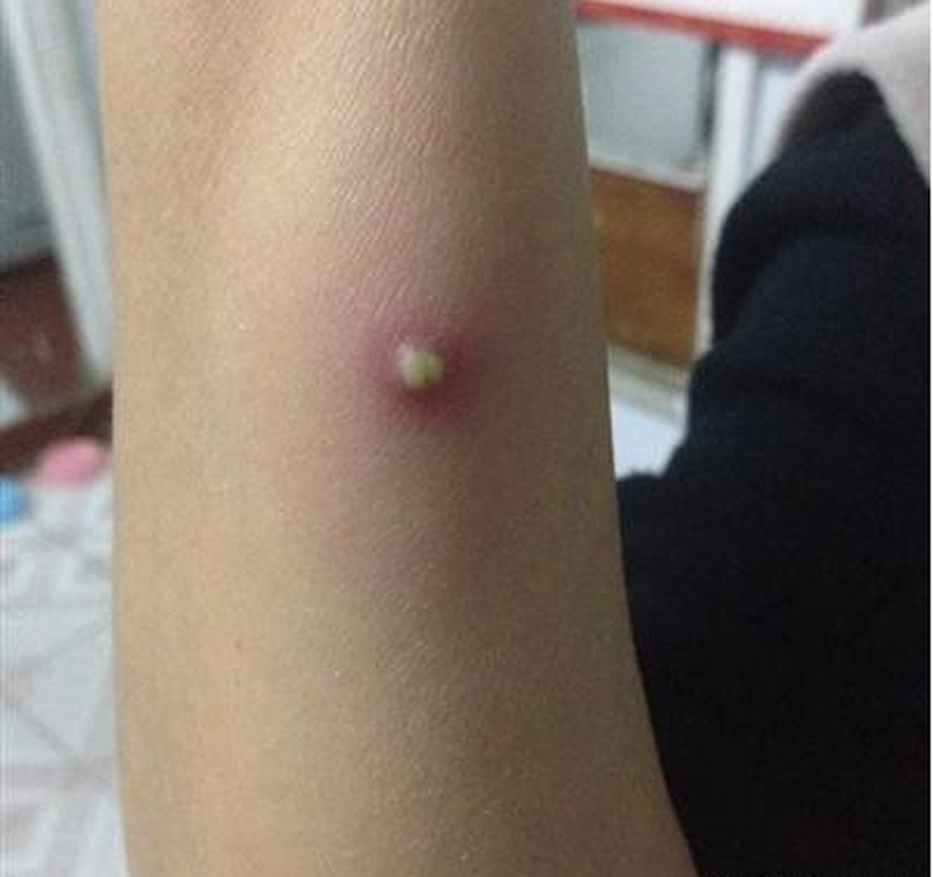 有网友询问刘医生,手臂上长了一个大脓包,又红又硬还疼,里面还有