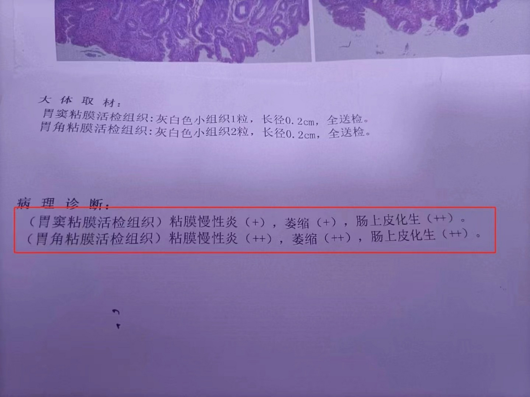 肠化是什么意思,你知道吗?