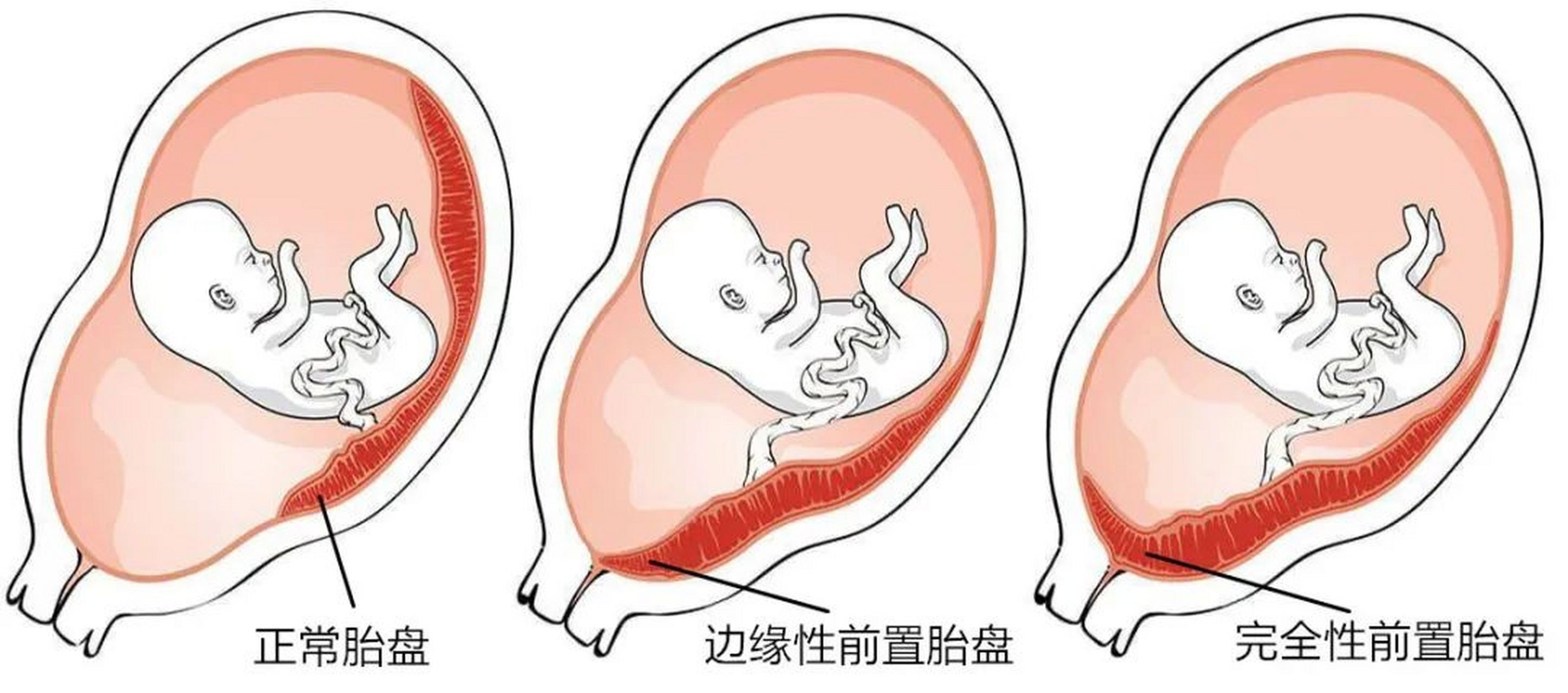 前置胎盘几个月时最危险? 前置胎盘越到孕晚期越危险!
