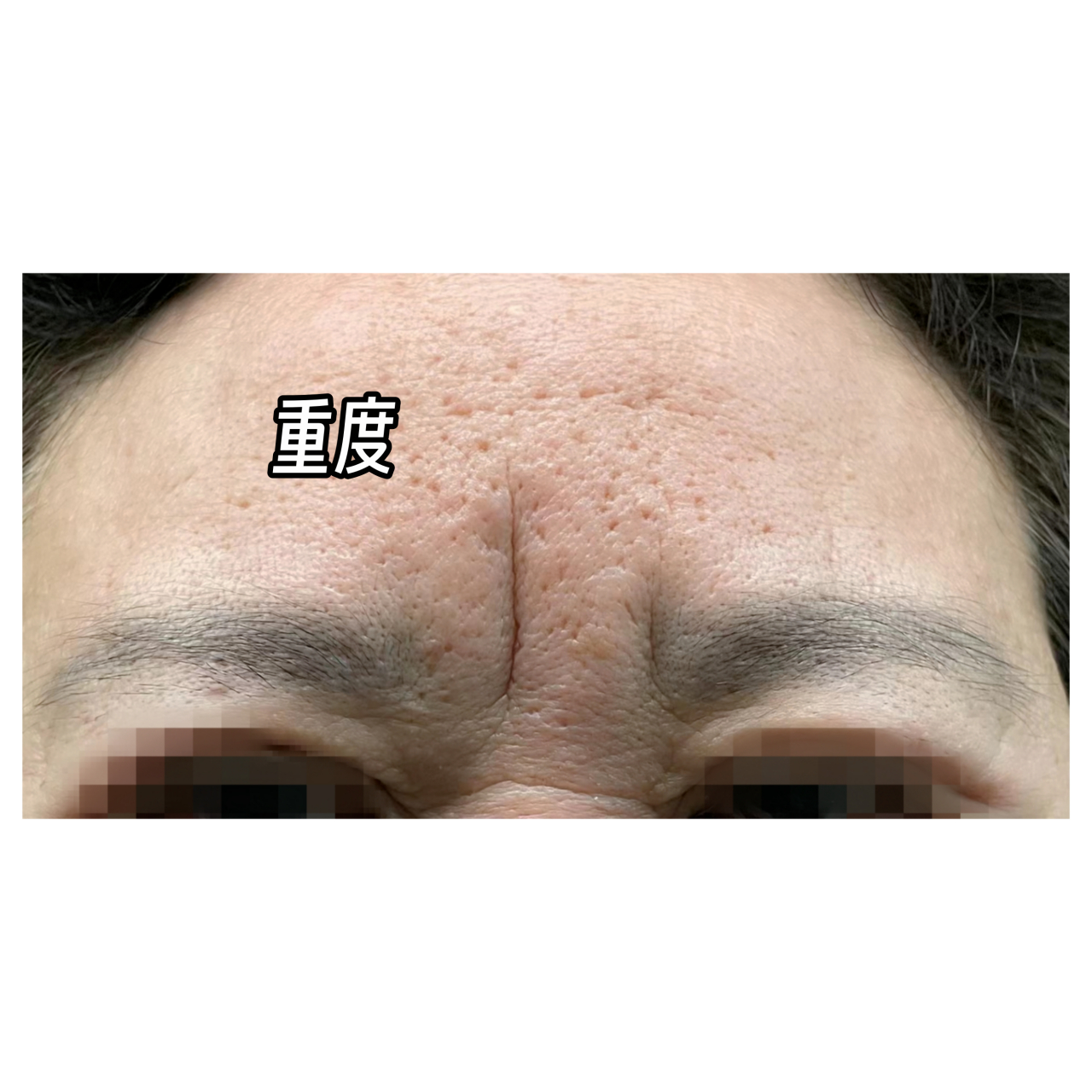 静态#川字纹# 发展历程: 早期印记较浅,中期印记加深开始凹陷,晚期