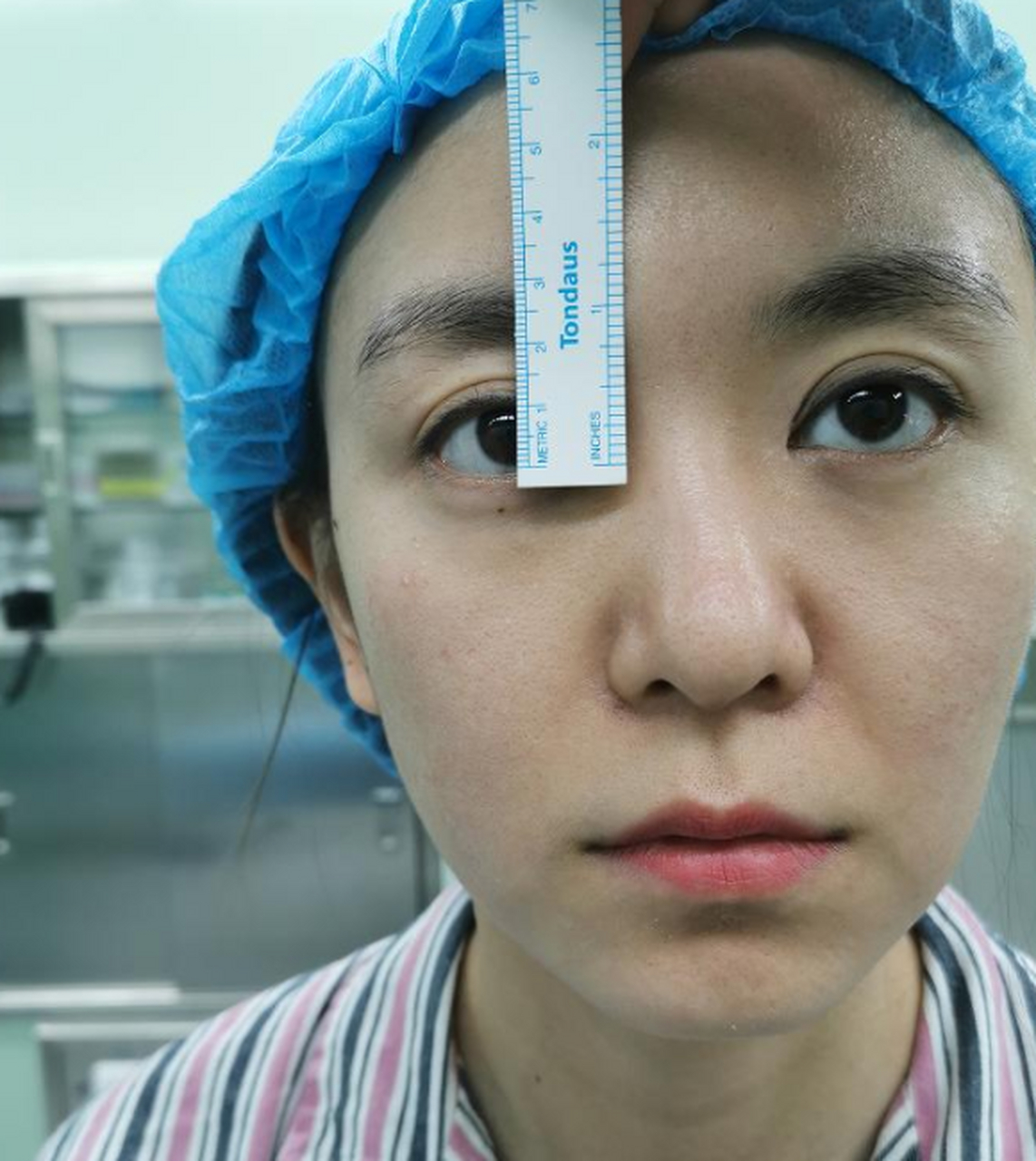 下图这位女患者下眼睑下垂,退缩,呈现三白眼,做完手术后眼神都变得