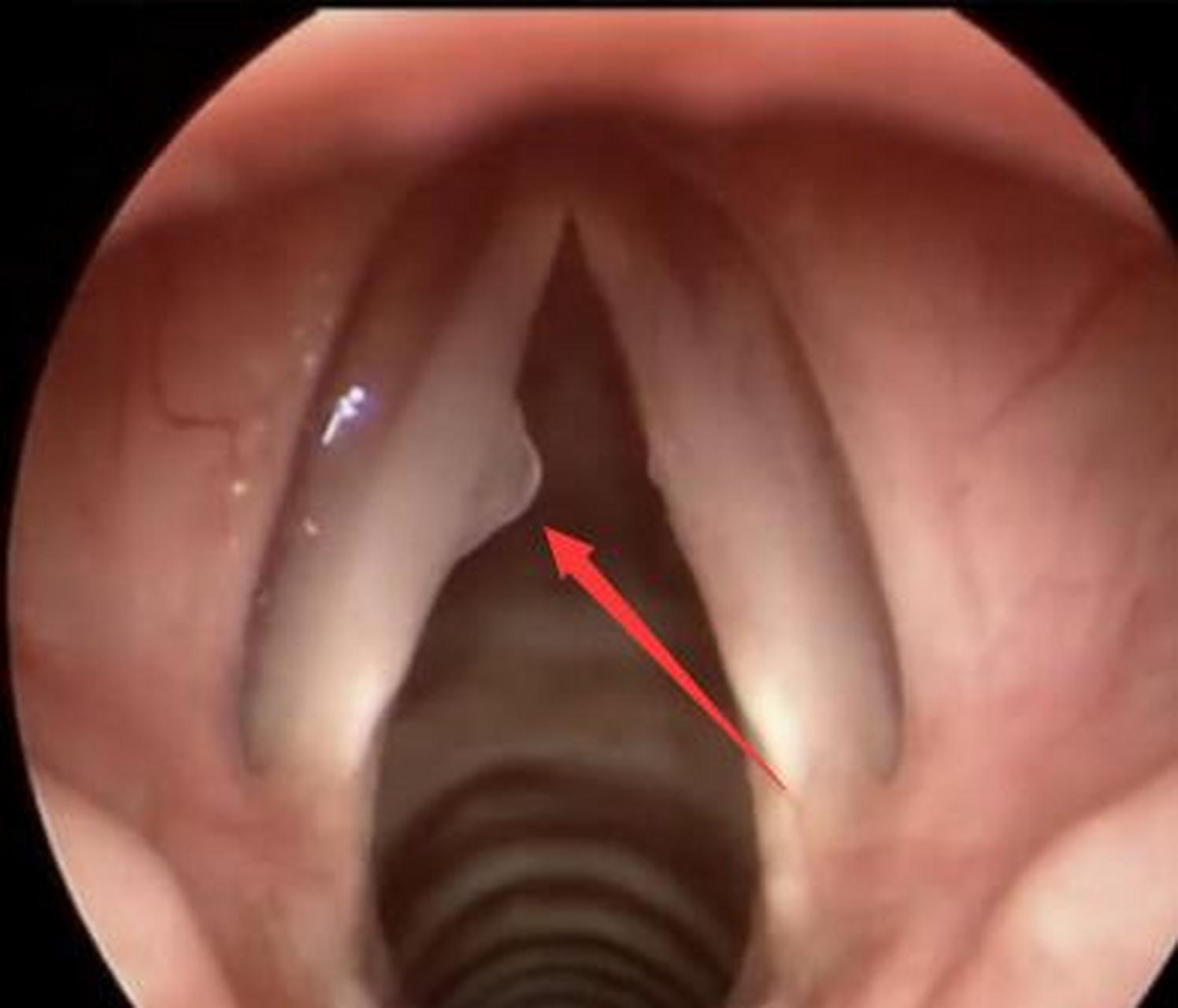 给大家看看声带息肉的样子 这是过度用嗓者职业病,比如老师[流泪]