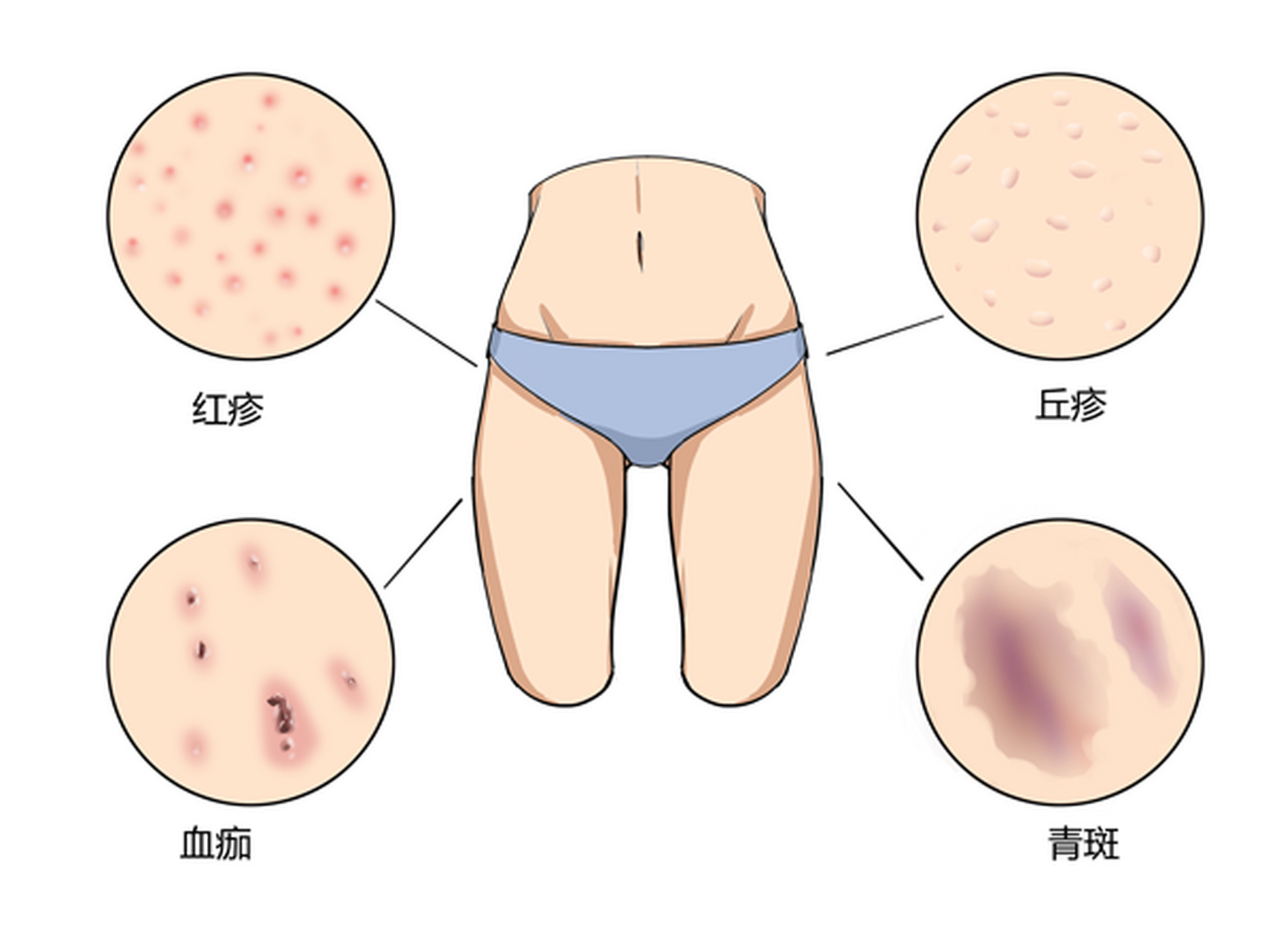 阴虱是什么  为什么会得阴虱?